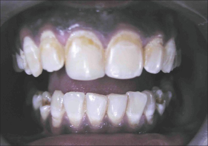 Fluoride Dangers Treatment for Dental Fluorosis