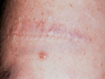 salabrasion tattoo removal-before and after - Tattoo design