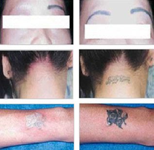 Tattoo Laser Removal