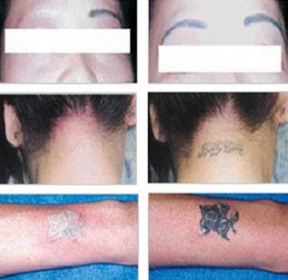 Laser Tattoo Removal Cost