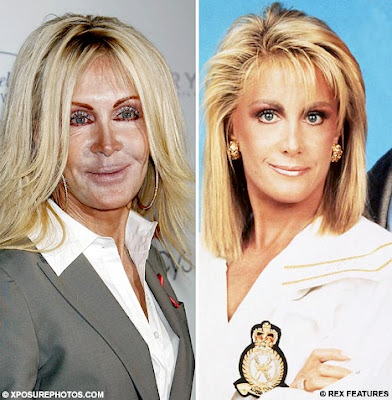 Celebrity Plastic Surgery Disasters: Joan Van Ark