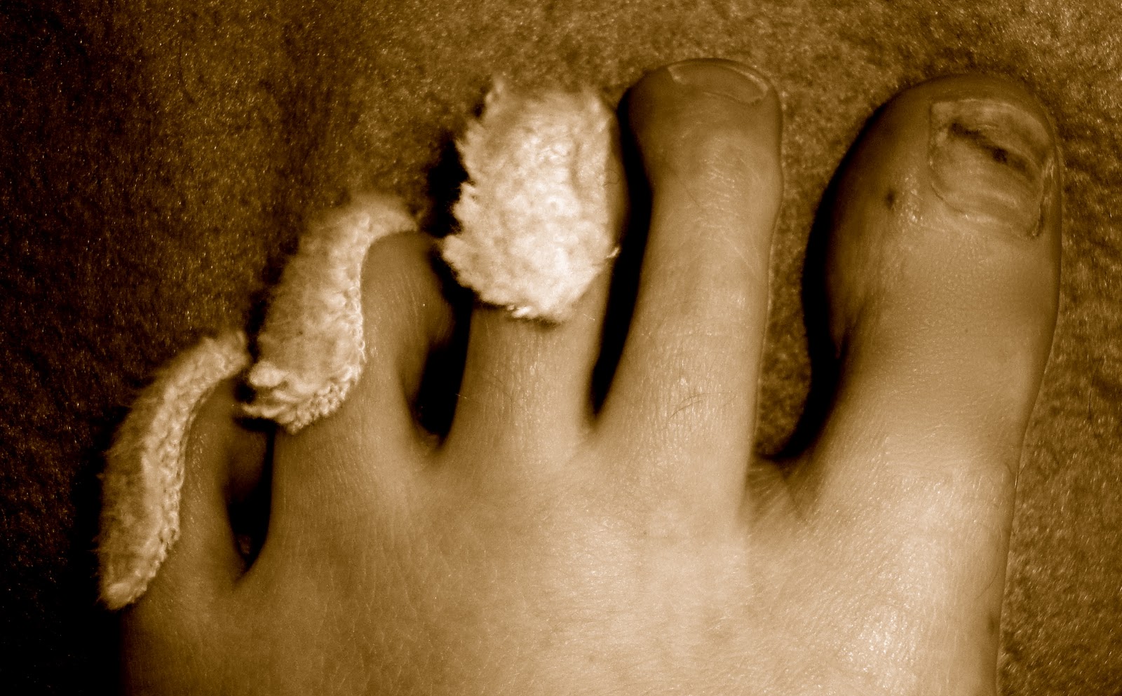 Peapat Goes Blog Sore Leg Sore Head (sorry for the minging bit about