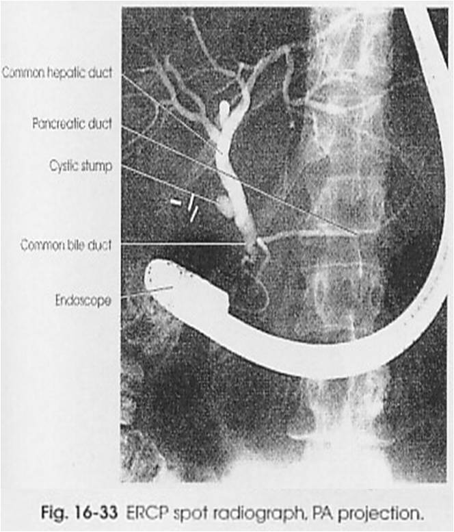 Twis's Blog Endoscopic Retrograde Choledocopancreatography (ERCP)