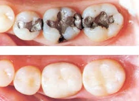 healing translucent tooth enamel healing translucent tooth enamel