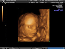 Sawyer 18 weeks