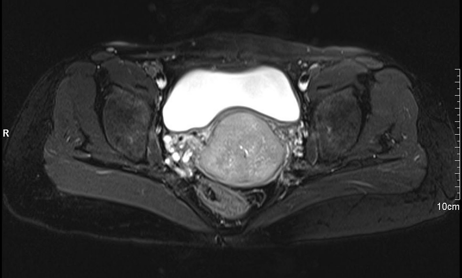 radiodiagnosis-imaging-is-amazing-interesting-cases-cervical