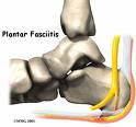 Heel Pain