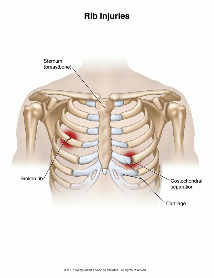 Припухлость ребра слева. Синдром Титце хондрит реберный. Ноет в грудине между ребрами. Выпуклая кость на грудине.