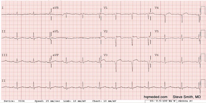 Dr. Smith&#39;s ECG Blog: Classic LV aneurysm (persistent ST elevation after previous MI)