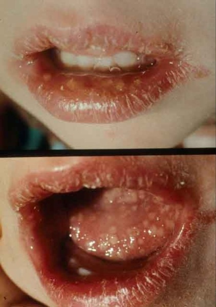 herpes on face cheek