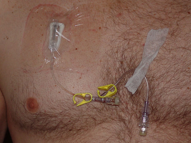 Marks Melon: 03/24/10 - Chemo Chest Port