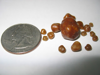 Gallbladder Stones: Size Of GallStones