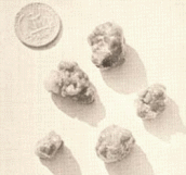 Gallbladder Stones: Size Of GallStones