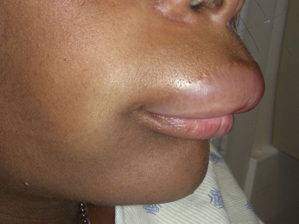 what is angioedema #10