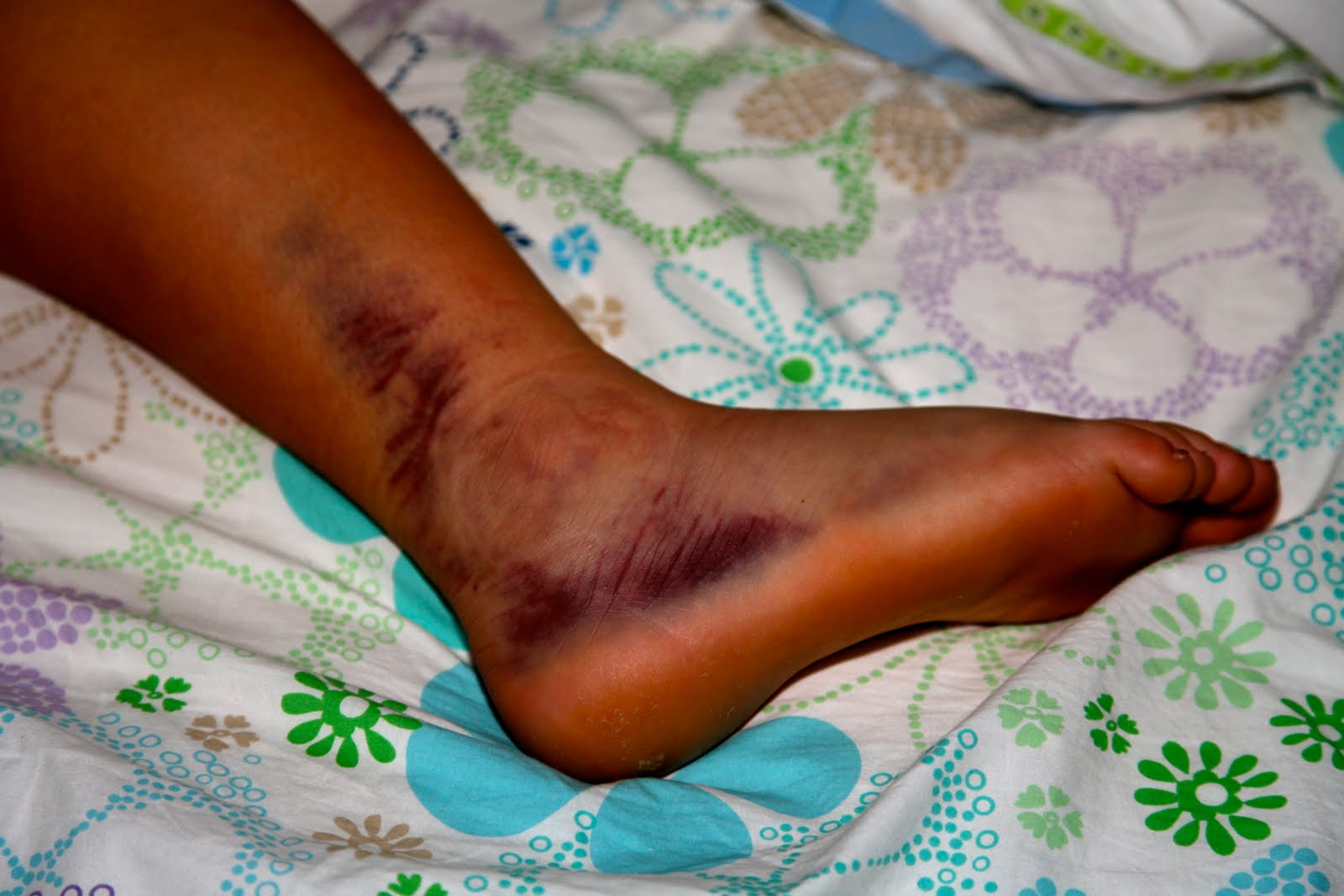 Ligament Tear healing Ankle