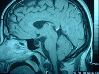 Lynne's CT & MRI Pathology Blogs: Empty Sellar Syndrome