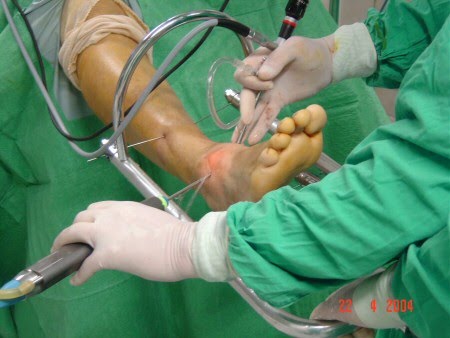Cirurgia coágulo no tornozelo sanguíneo após