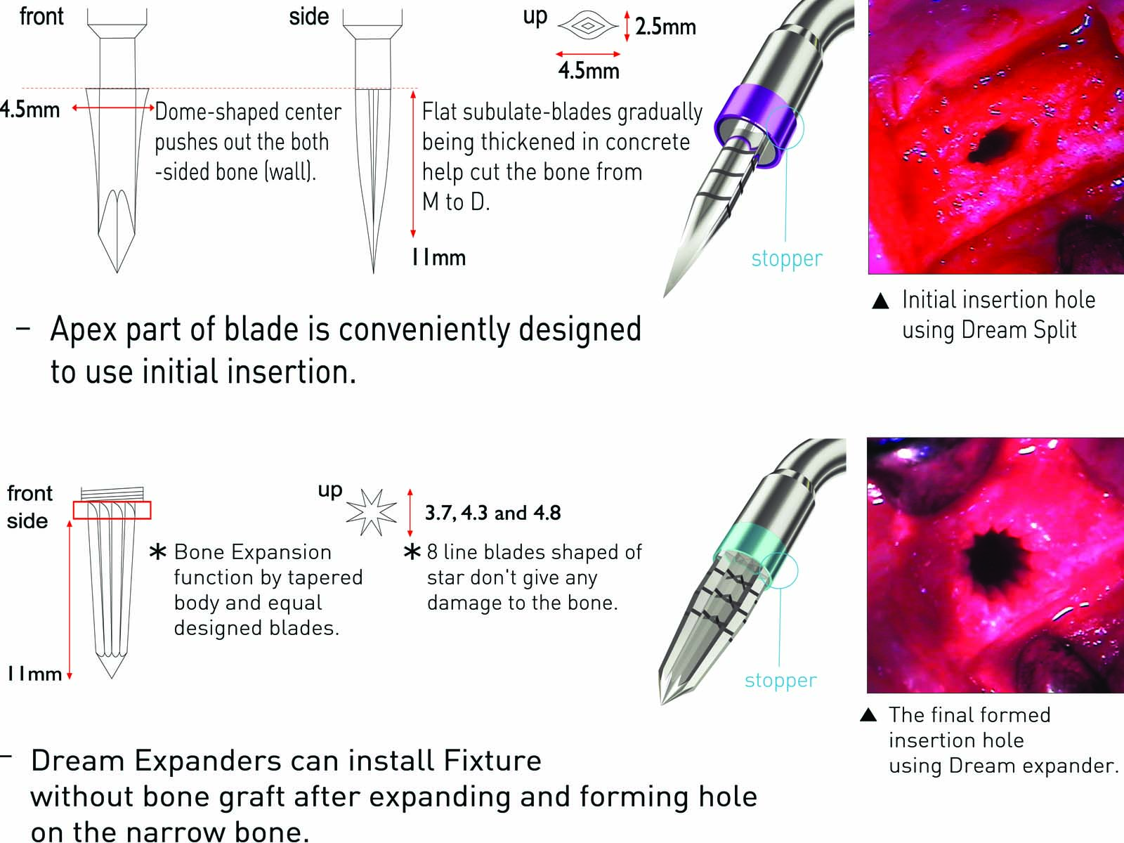 Ibs Rod IBS Implant: Innovative IBS Implant System
