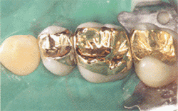 [Hohaus14gold+onlay.gif]