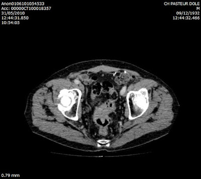 Rectum tumor majmetastasissal