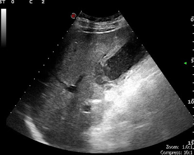 Cholecystitis calculosa