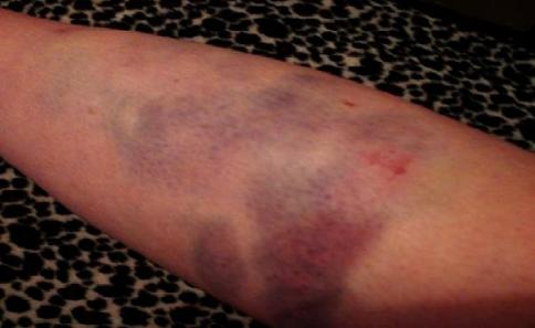 [bruised+arm.jpg]