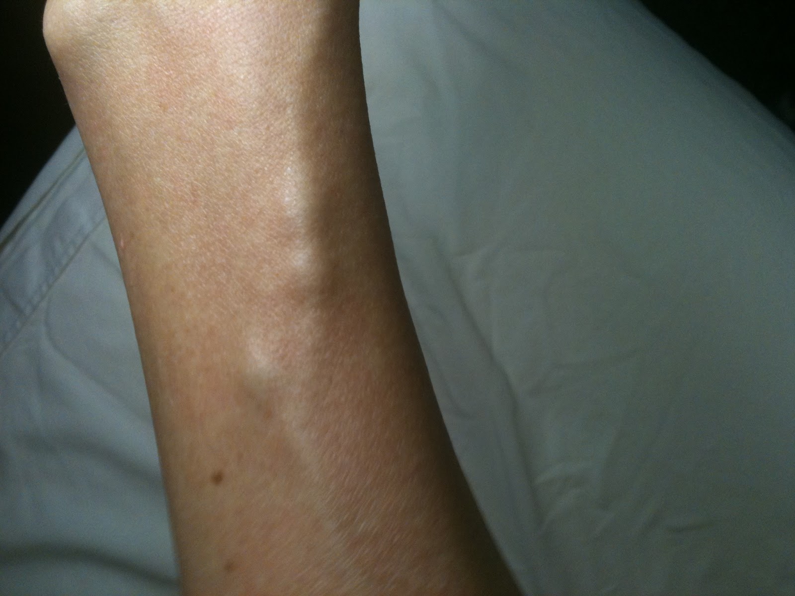 Strabismus Blog by Greta Weisman No pain just vein