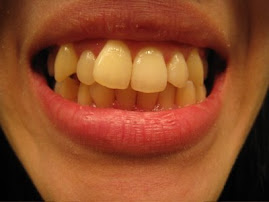 My teeth (2 weeks) -2008