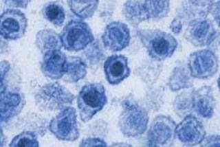 xenotropic murine leukemia virus-related virus -- XMRV