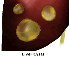Natural Way To Treat Fatty Liver Disease Natural Way To Treat Fatty Liver Disease