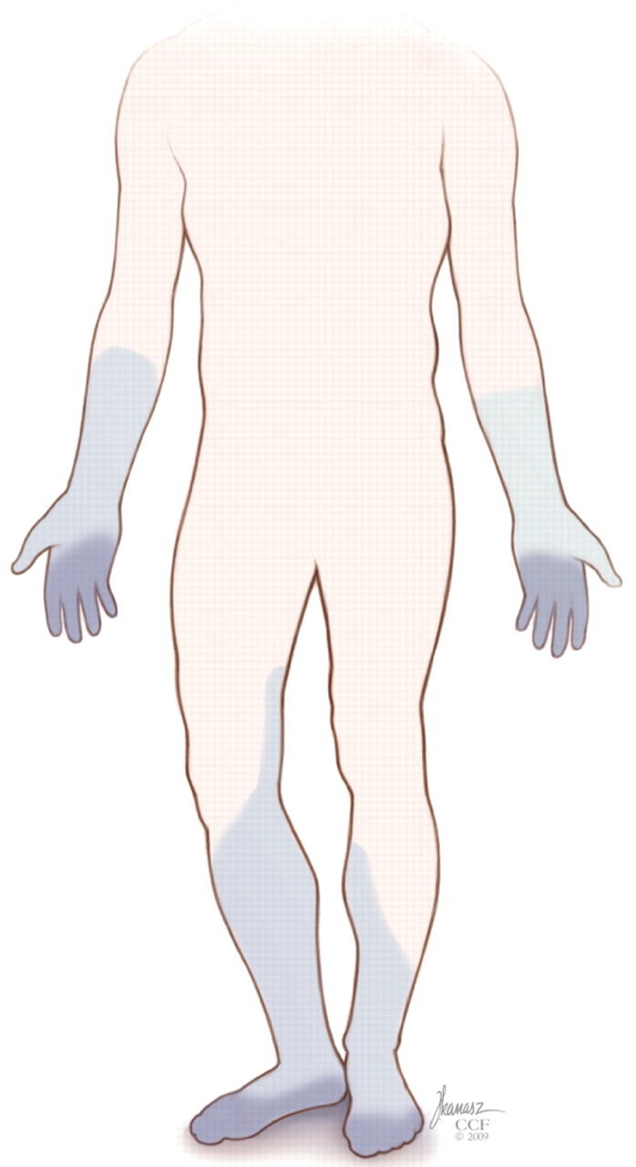 Small fiber neuropathy A burning problem