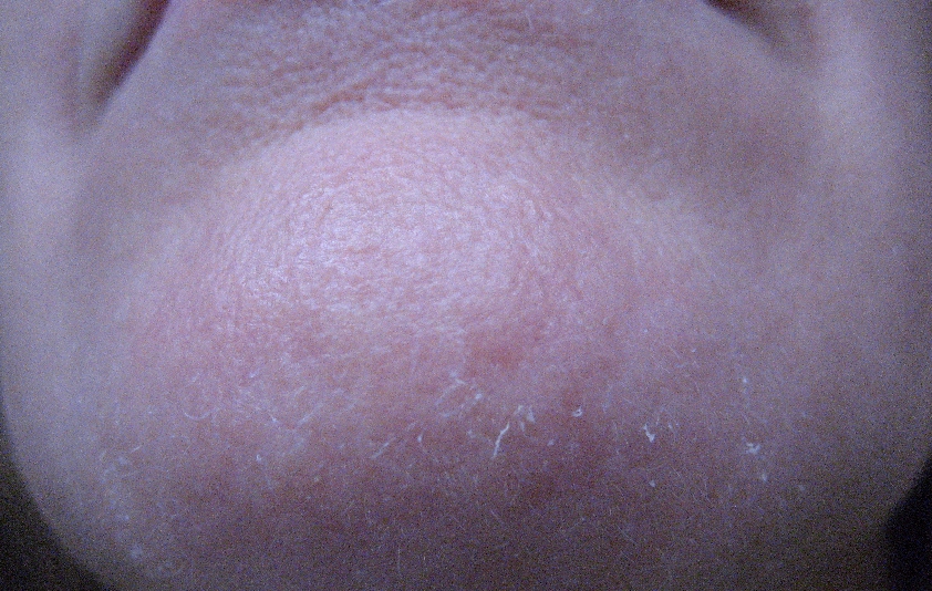 Chemical Peels for Acne and Anti Aging RetinA Peeling