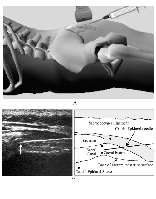 Caudal Epidural Local Anesthetic at Lawrence Guthrie blog