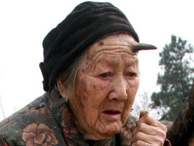 anciana-china-101-anos-crece-cuerno-negro-seis-centimetros