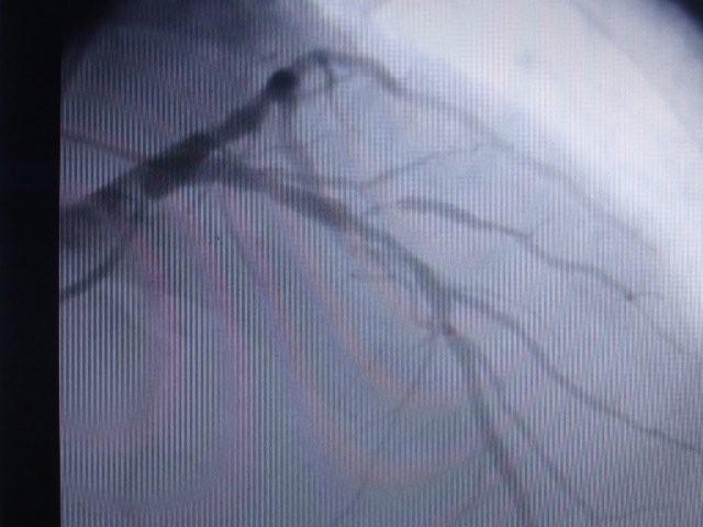 [Before+Left+Arterior+Descending+and+Circumllex+Artery.jpg]