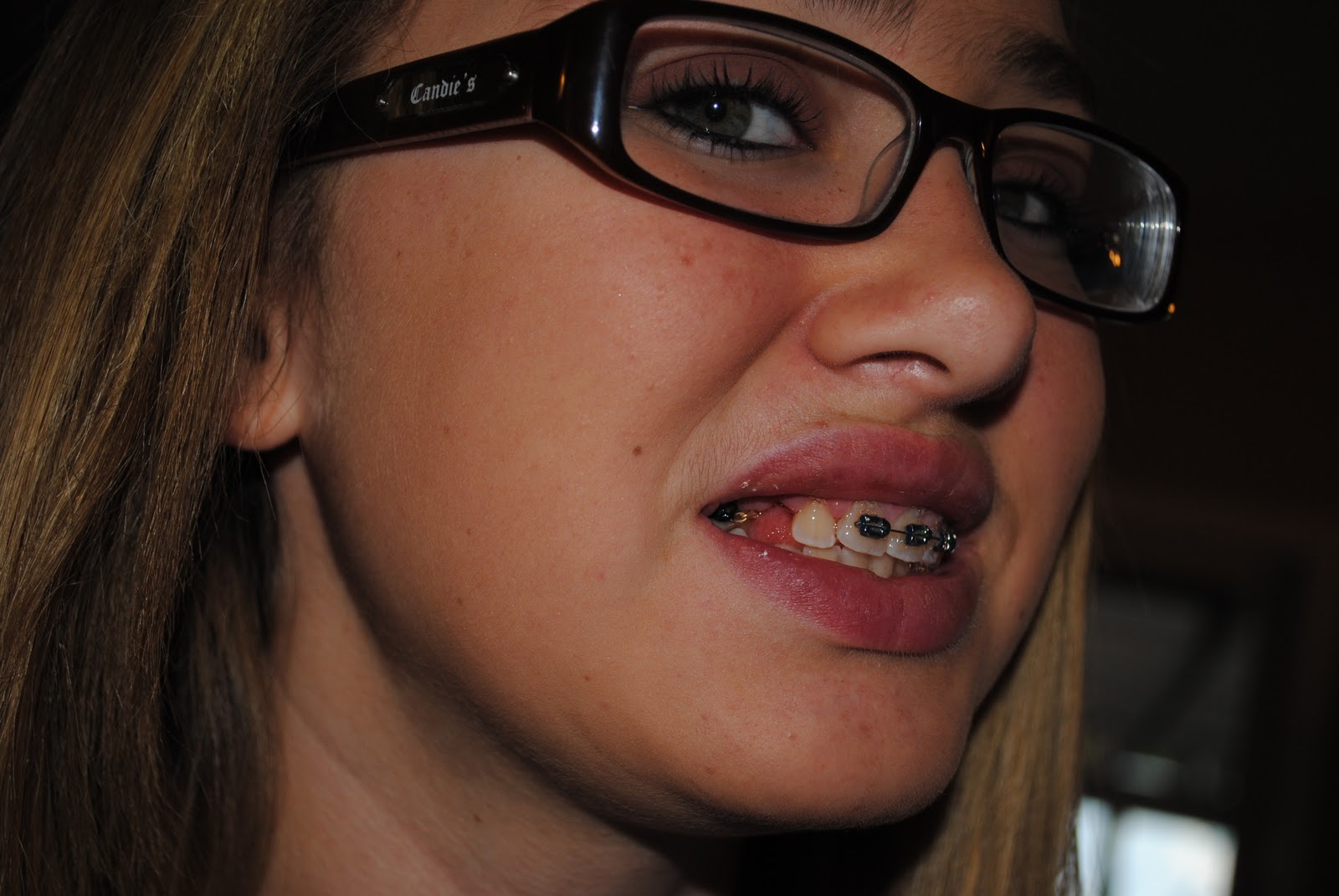 Our "Bliss"ful Days Nicole and her tooth trauma