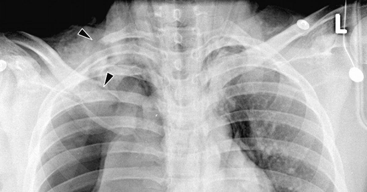 RadiologySpirit: rupture trachea