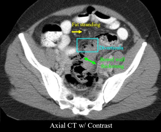 Can You See Diverticulitis On A Ct Scan Without Contrast Ct Scan Machine