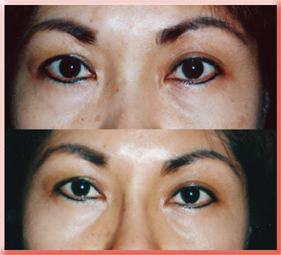 asian upper eyelid