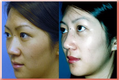 asian rhinoplasty