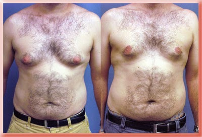 gynecomastia