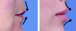 aging changes of the lips