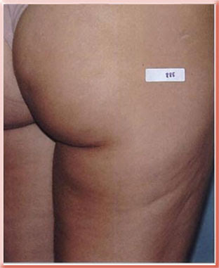 grade 2 cellulite