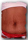 abdominal stretchmarks of pregnancy