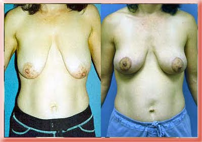 breast lift mastopexy Los Angeles breast lift mastopexy Los Angeles