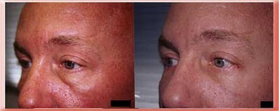 tear trough and protruding eyelid fat in a younger patient