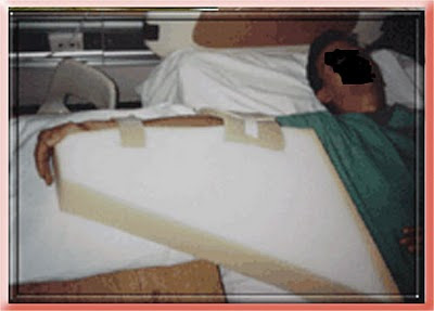 airplane splint
