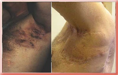 hidradenitis armpit