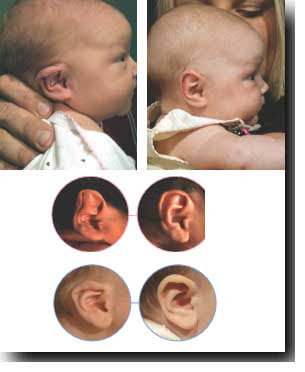 splint for baby ear deformities