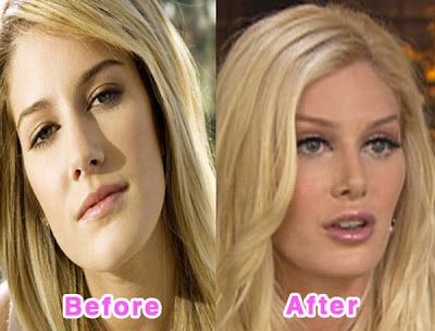 heidi montag before and after all surgery. 2010 Heidi Montag Before After